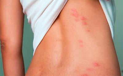 Сыпь на коже