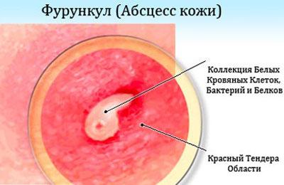 Абсцесс кожи