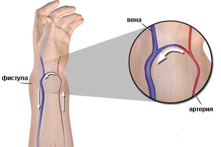 Гемодиализ