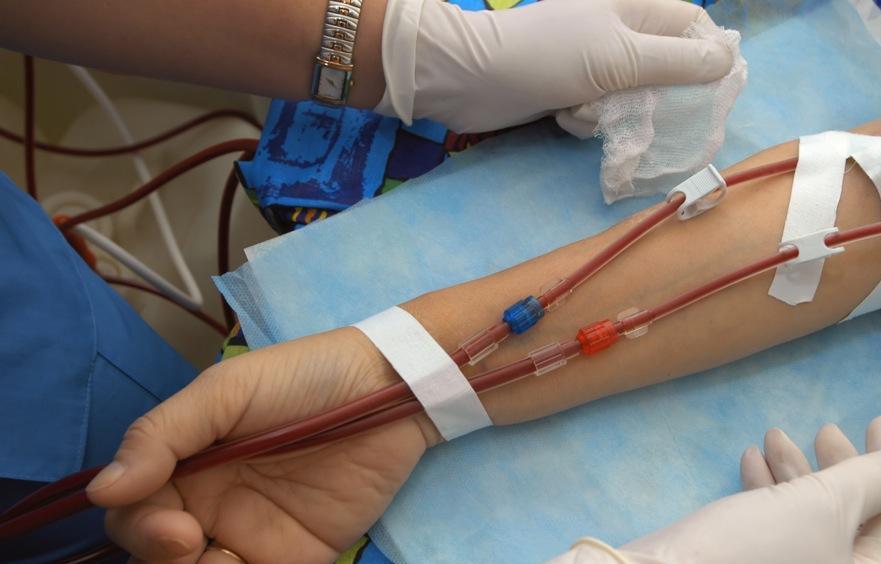 Гемодиализация