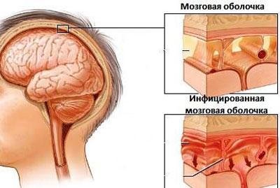Проявление менингита