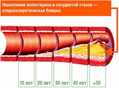 Образование холестериновой бляшки