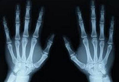 Рентген кистей рук