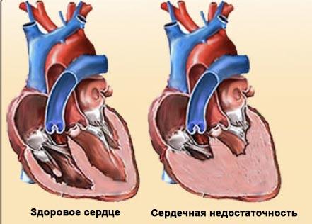 Хроническая сердечная недостаточность