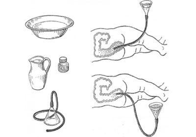 Проведение клизмы