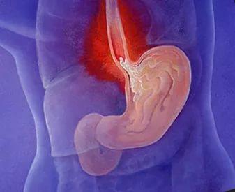 острая боль в пищеводе и желудке;