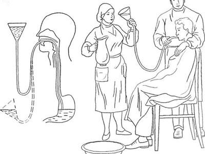 Схема промывания желудка