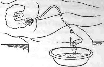 Сифонный метод промывания кишечника