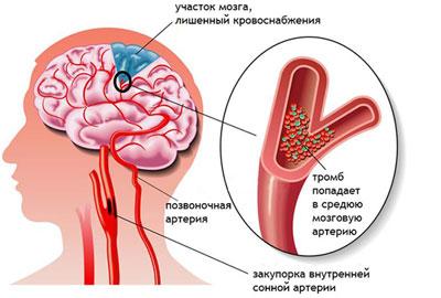 Причина инсульта