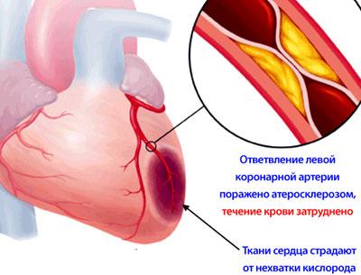 Ишемическая болезнь сердца