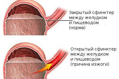 Возникновение изжоги