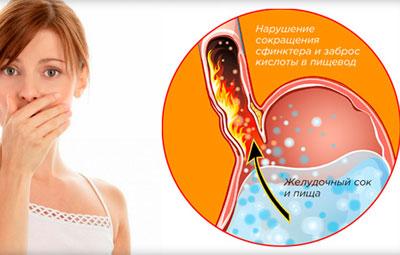 Причина изжоги