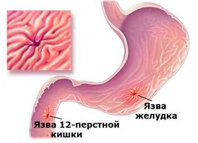 Язвенная болезнь