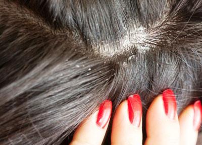 Перхоть в волосах