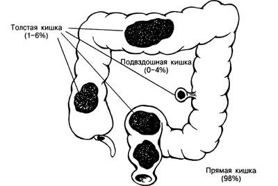 Каловые камни