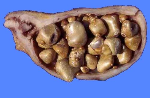 Камни в жёлчном пузыре