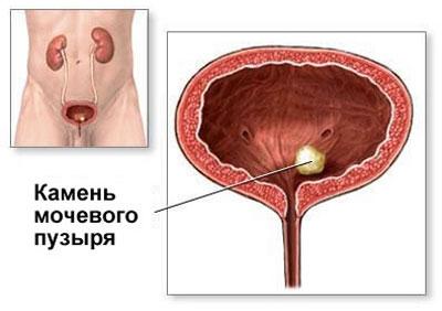Камень в мочевом пузыре
