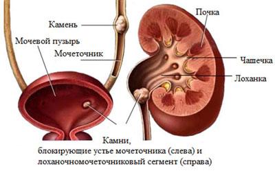 Мочекаменная болезнь