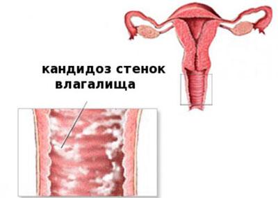 Вагинальный кандидоз