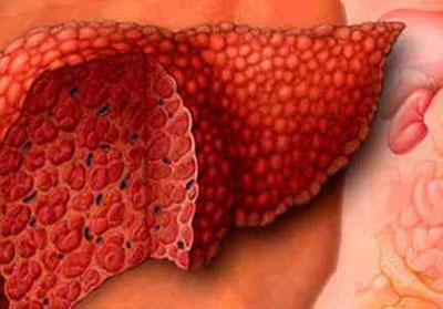 Печень при циррозе