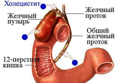 Проявление холецистита