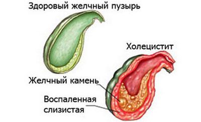 Признаки холецистита