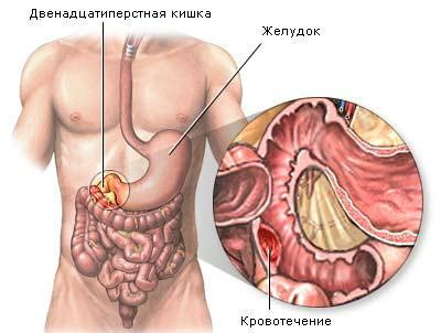 Кишечное кровотечение