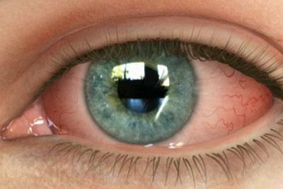 Проявление конъюктивита