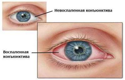 Проявление конъюктивита