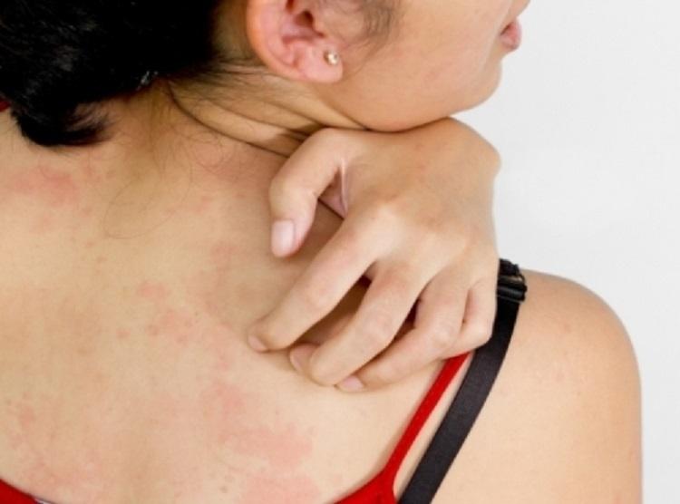 Крапивница