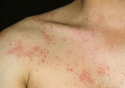 Крапивница на теле