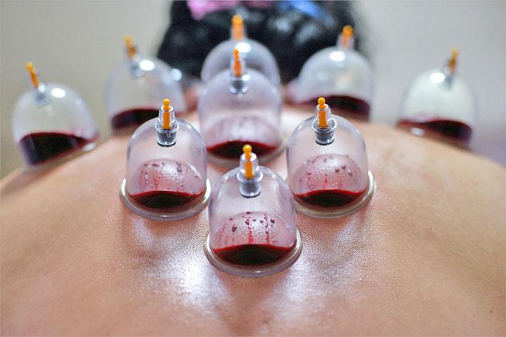 Кровопускание