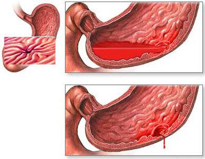 Желудочно-кишечное кровотечение