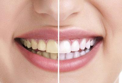 Зубы после отказа от курения