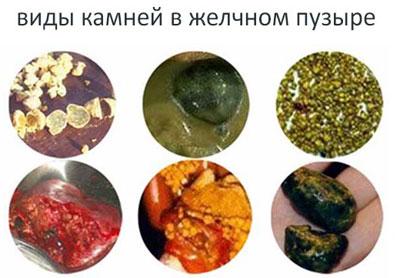 Камни из желчного пузыря