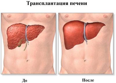 Печень после трансплантации