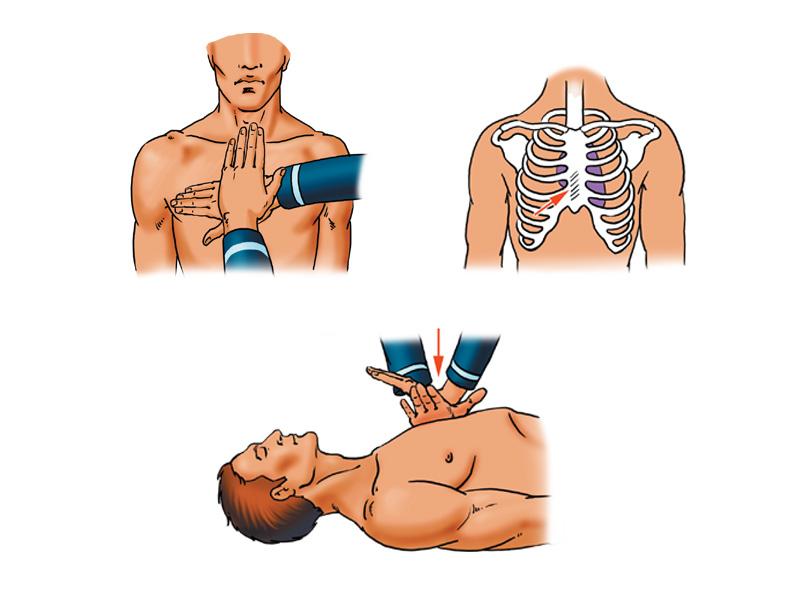 Непрямой массаж сердца