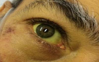 Желтуха у мужчины