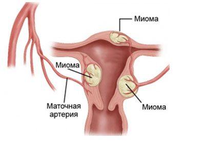 Миома матки