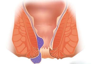 Внутренний и внешний геморрой
