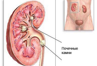 Камни в почках