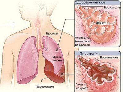 Проявление пневмонии