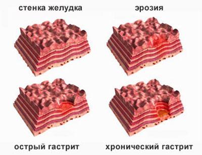 Желудок при гастрите