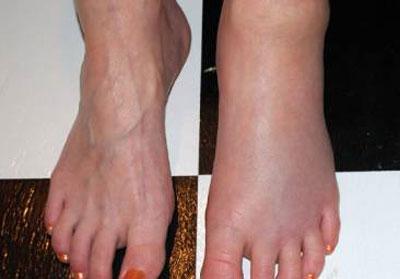 Отечность ног