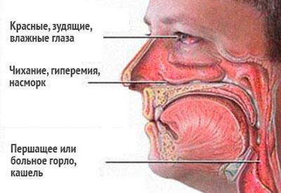 Симптомы отека квинке