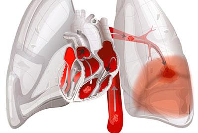 Отек легких