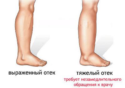 Отек ног