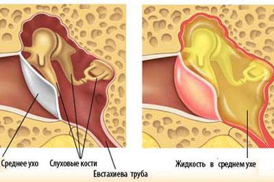 Воспаление среднего уха