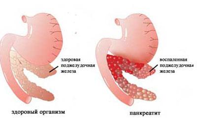 Проявление панкреатита