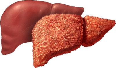 Изменение печени при алкоголизме